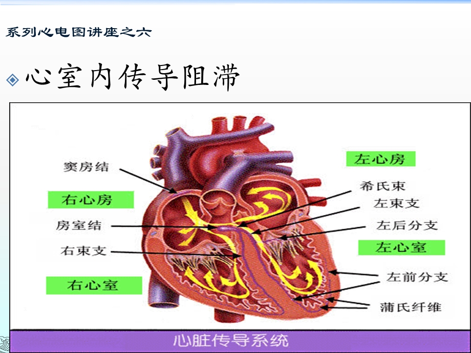 8心室内传导阻滞.ppt_第1页