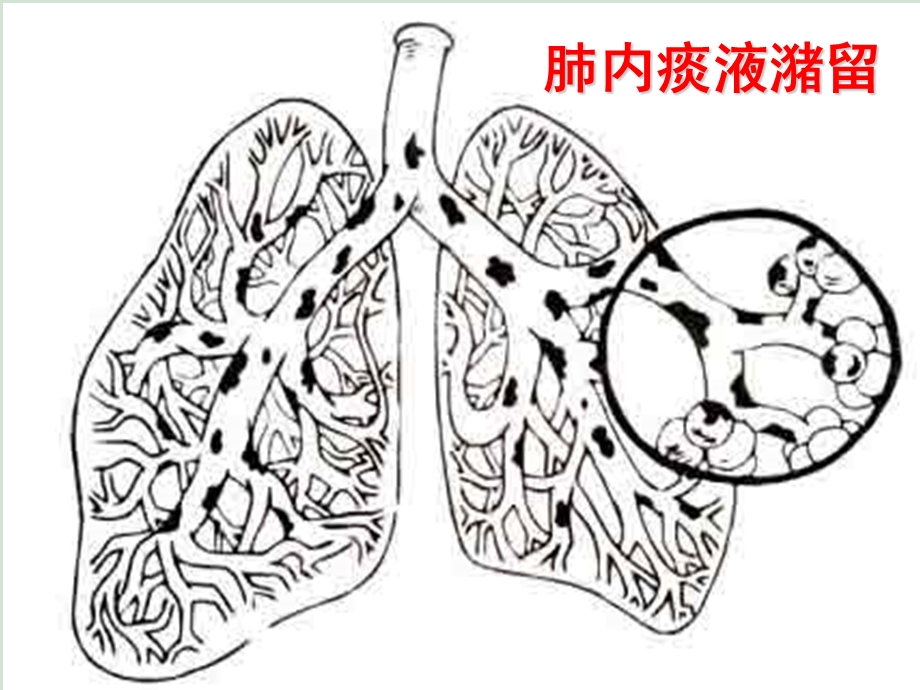 教学PPT胸部物理治疗.ppt_第3页