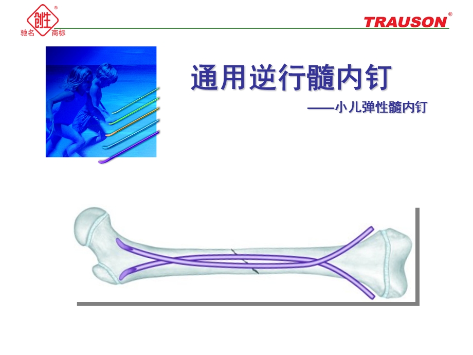 通用逆行髓内钉—小儿弹性髓内钉.ppt.ppt_第1页