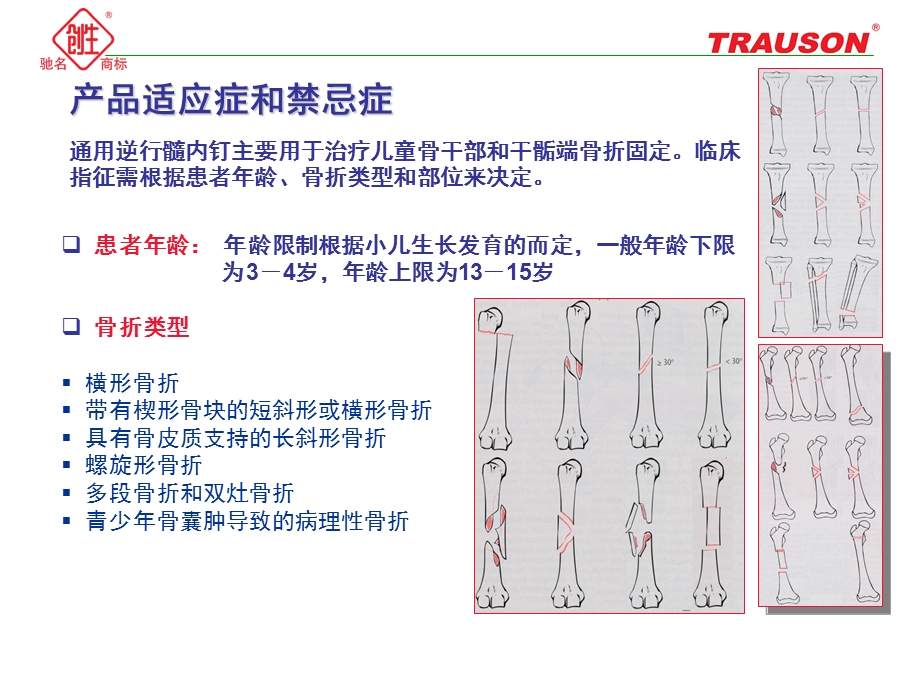 通用逆行髓内钉—小儿弹性髓内钉.ppt.ppt_第3页