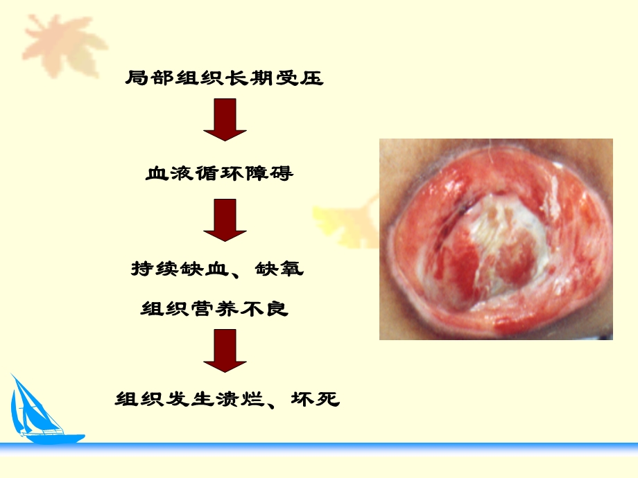 压疮预防及护理.ppt_第3页