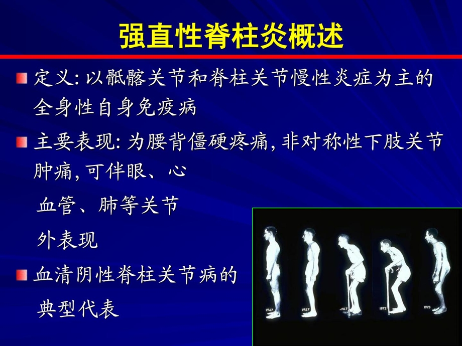 强直性脊柱炎的诊断和治疗[指南].ppt_第2页