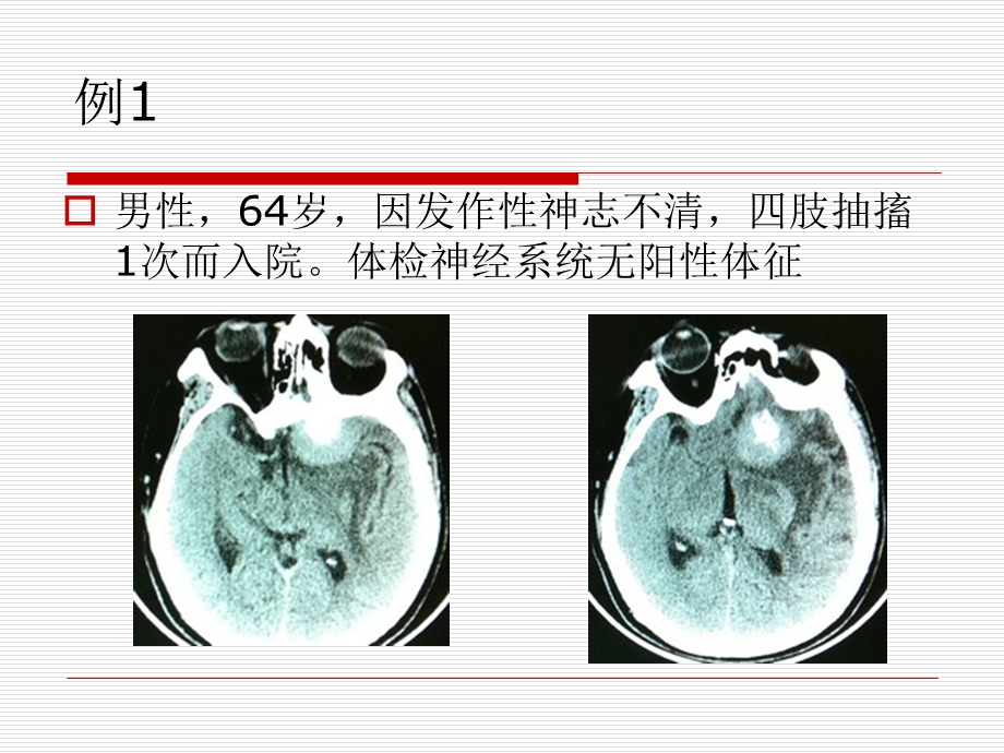 开颅手术中血管损伤的经验教训.ppt_第2页