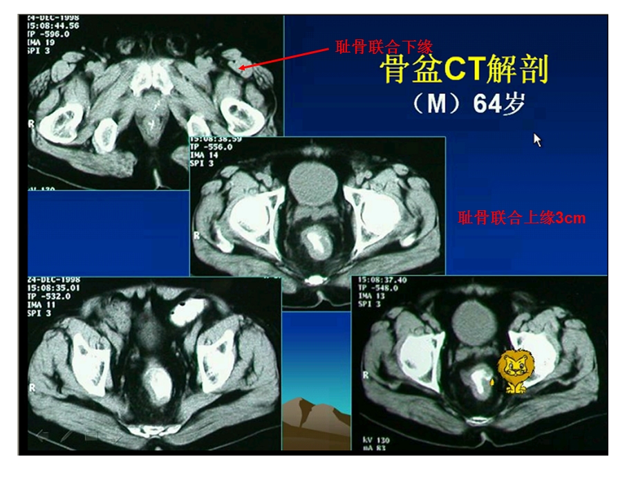 CT上岗证视频(盆腔).ppt_第3页