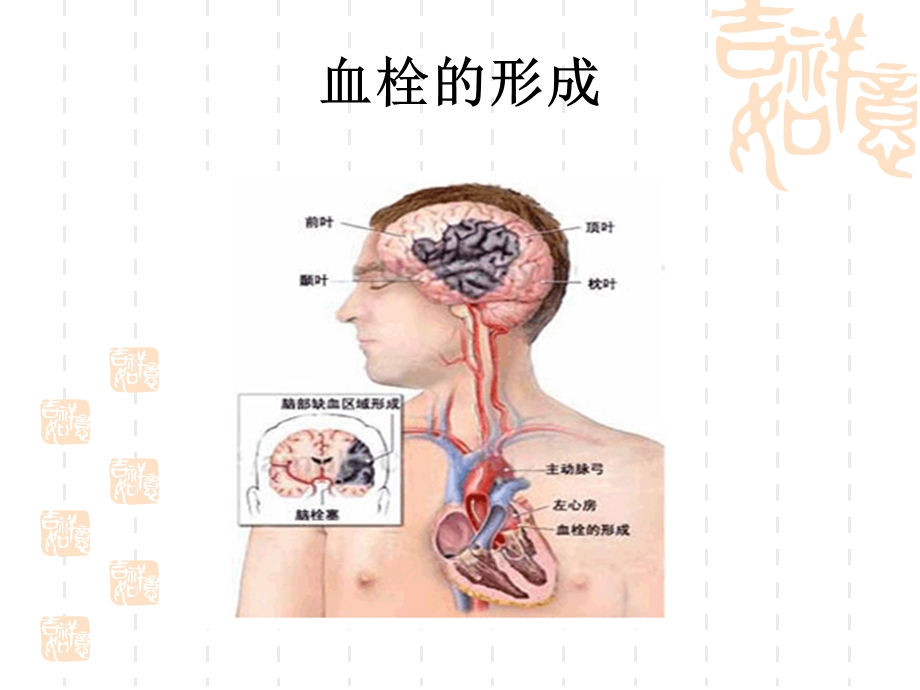 不同部位脑梗的临床表现.ppt_第2页