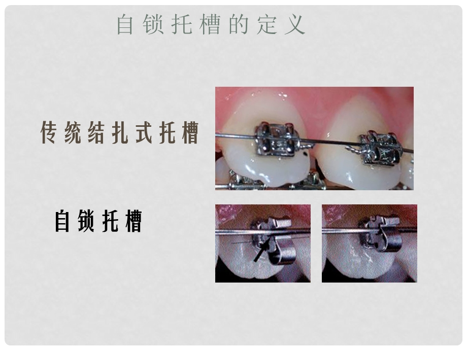 自锁托槽矫治技术.ppt南京医科大学.ppt_第3页