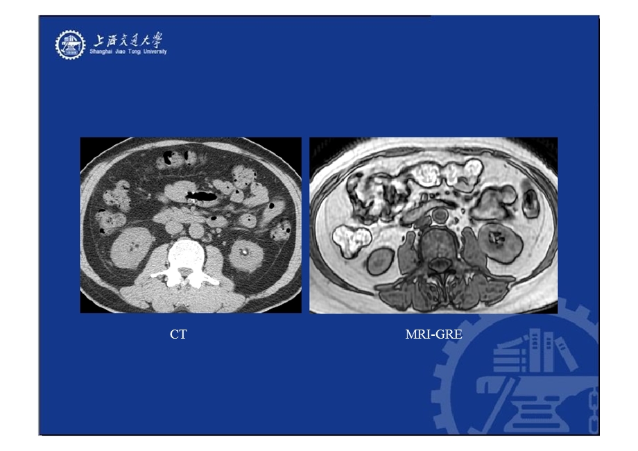 腹膜后间隙病变的影像诊断.ppt_第3页