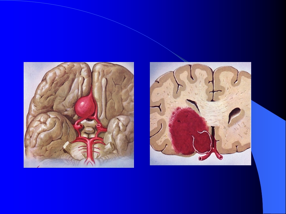 颅内动脉瘤.ppt_第3页