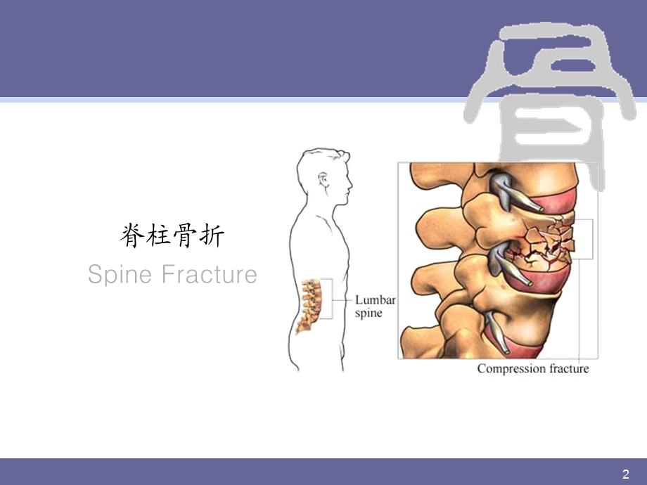 1062709044脊柱骨折.ppt.ppt_第2页