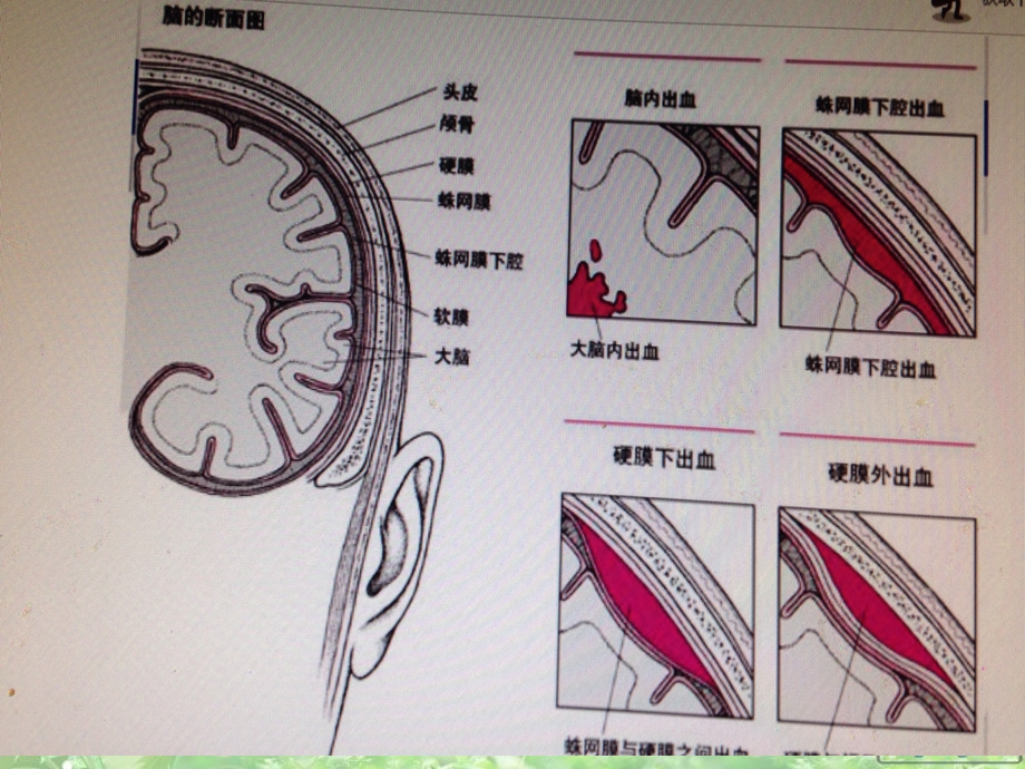 脑出血病人的护理.pptll.ppt_第3页