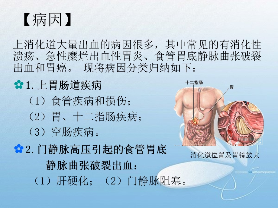 上消化道出血(1).ppt_第3页