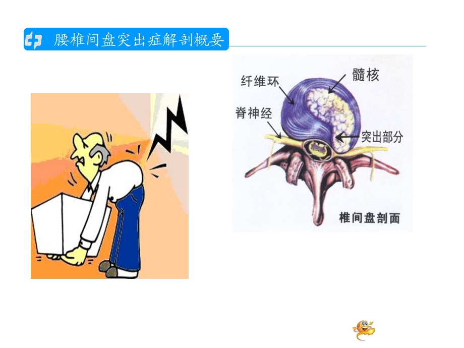 腰椎间盘突出的护理查房1.ppt_第3页