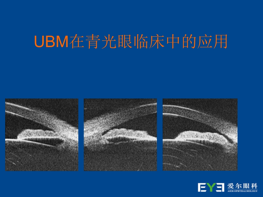 UBM在青光眼临床中的应用.ppt_第1页