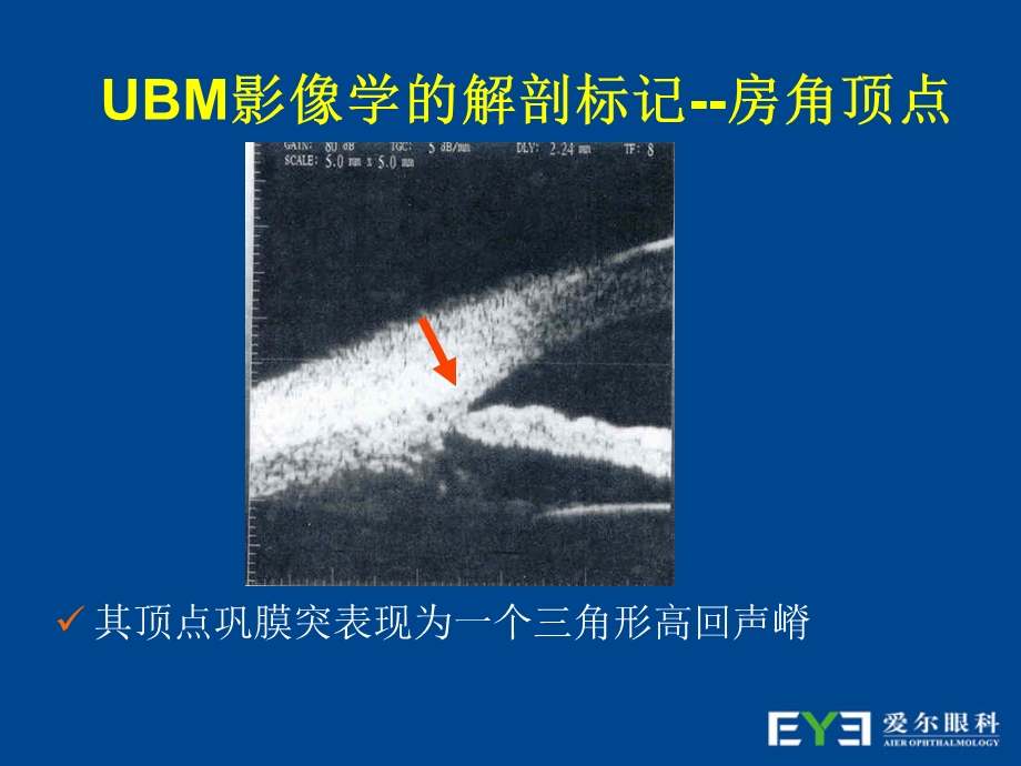 UBM在青光眼临床中的应用.ppt_第3页