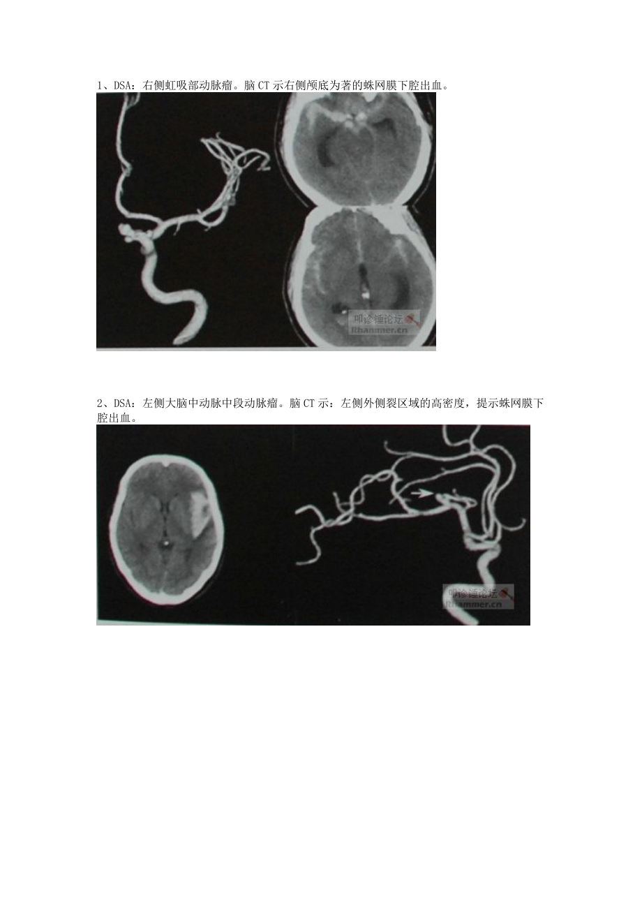 不同部位所致蛛网膜下腔出血的头颅CT表现.doc_第1页