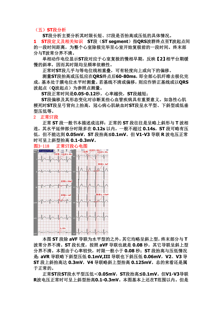 另类心电图学讲义9ST段分析.doc_第1页