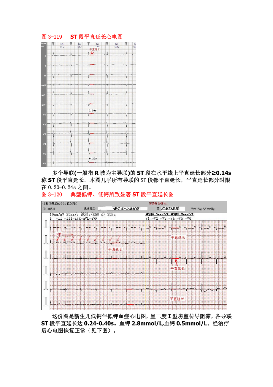 另类心电图学讲义9ST段分析.doc_第3页