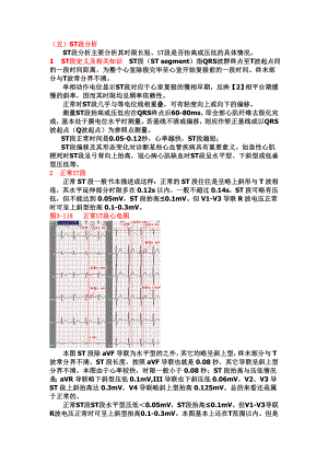 另类心电图学讲义9ST段分析.doc