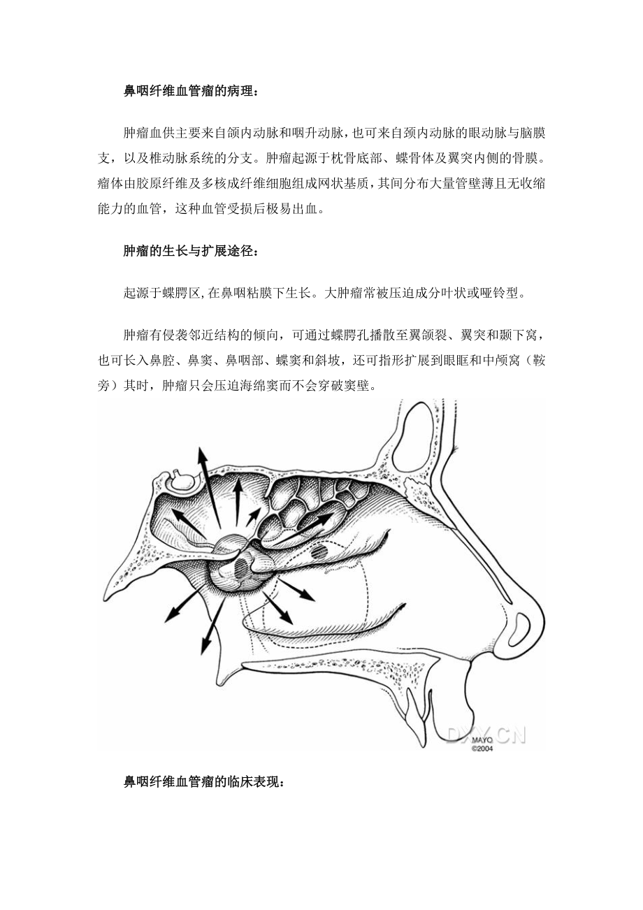 鼻咽纤维血管瘤.doc_第2页