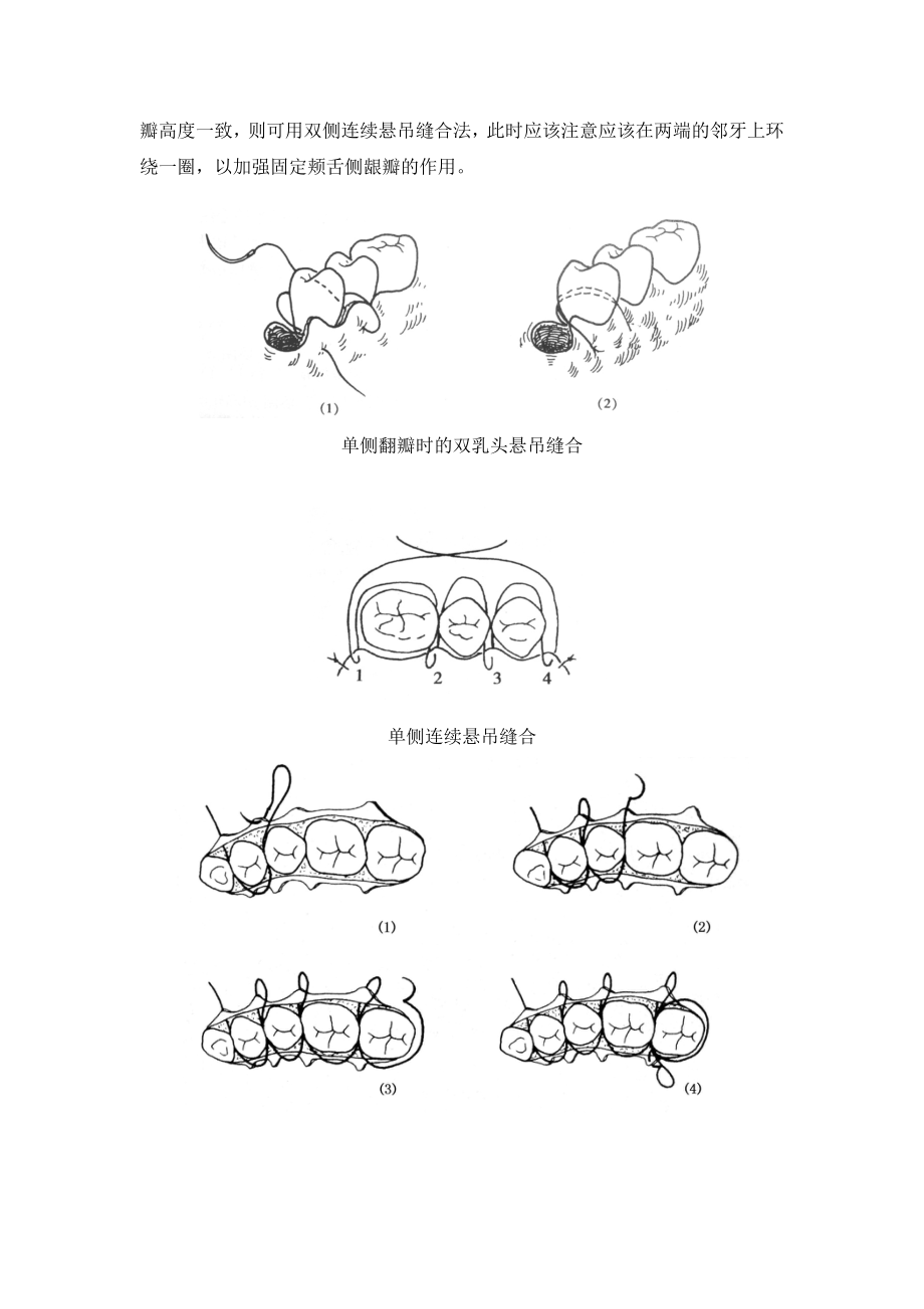 口内缝合术.doc_第3页