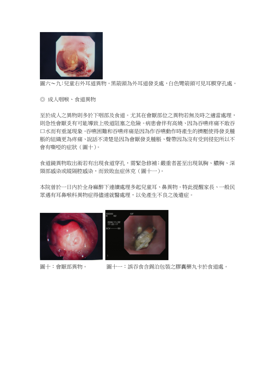 耳鼻喉异物.doc_第2页