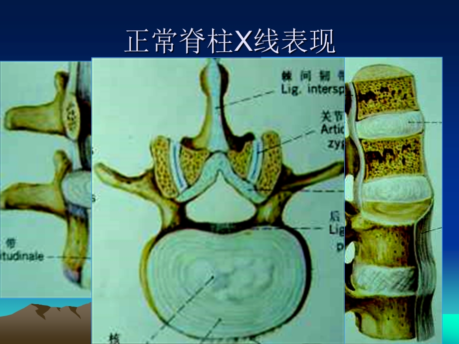 医学影像学：脊柱的正常影像表现及退行性病变课件.ppt_第3页