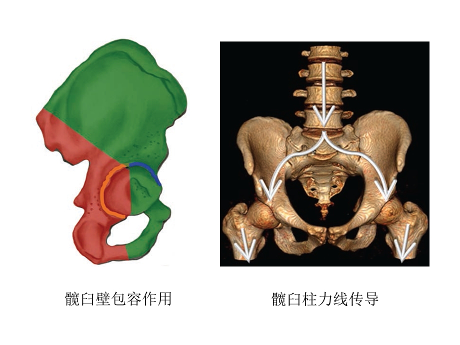 髋臼骨折影响评估及入路选择课件.ppt_第3页