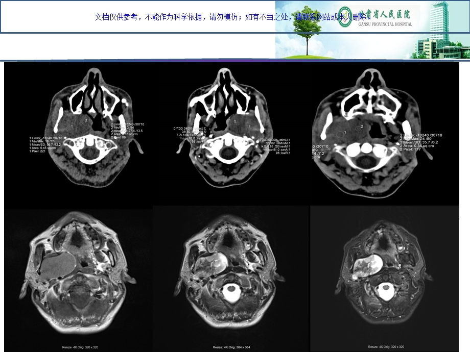 咽旁间隙病变的影像诊疗和鉴别ppt课件.ppt_第2页