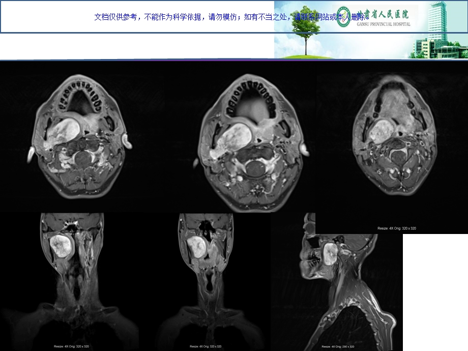 咽旁间隙病变的影像诊疗和鉴别ppt课件.ppt_第3页