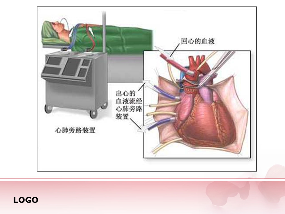 体外循环心脏术后并发症的观察和护理主题讲座ppt课件.ppt_第2页