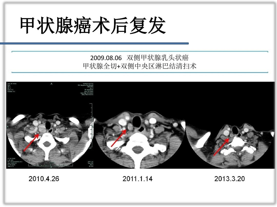 右喉返神经后方淋巴结清扫在PTC中的价值课件.ppt_第3页