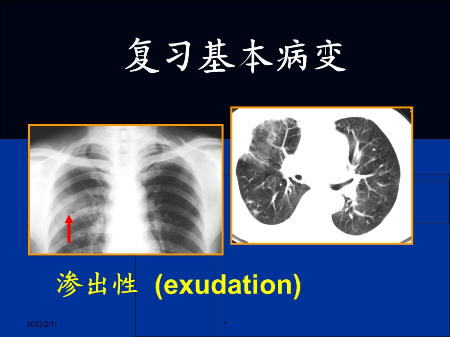 医学影像学：呼吸系统(二)课件.ppt_第3页