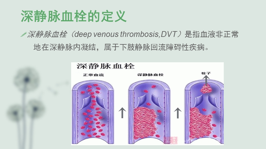 医学深静脉血栓评估培训ppt课件.ppt_第2页