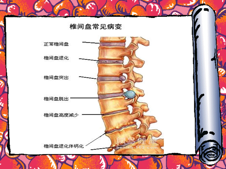 颈椎病的护理查房课件.ppt_第2页