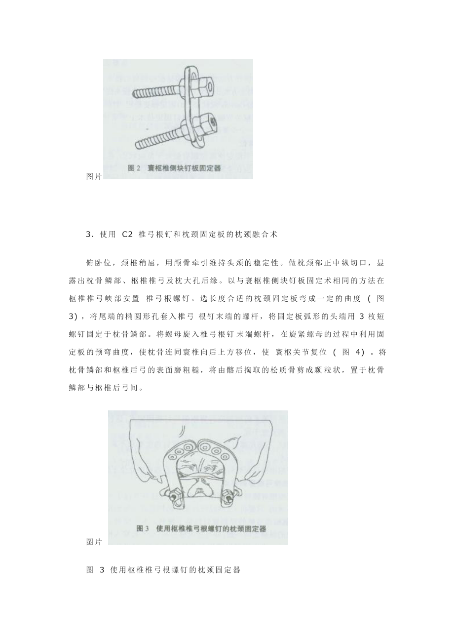 寰枢关节后路融合术.doc_第3页