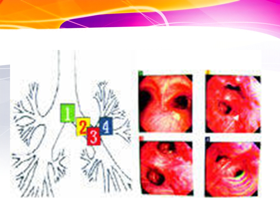 咯血的诊断与治疗课件.ppt_第3页