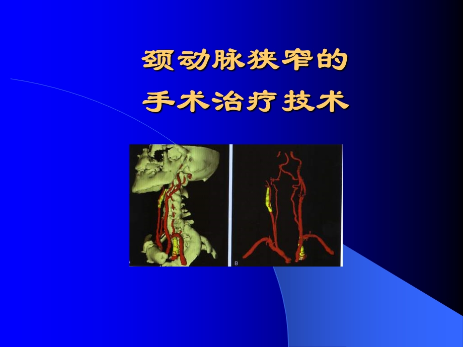 颈动脉狭窄的手术治疗技术课件.ppt_第1页