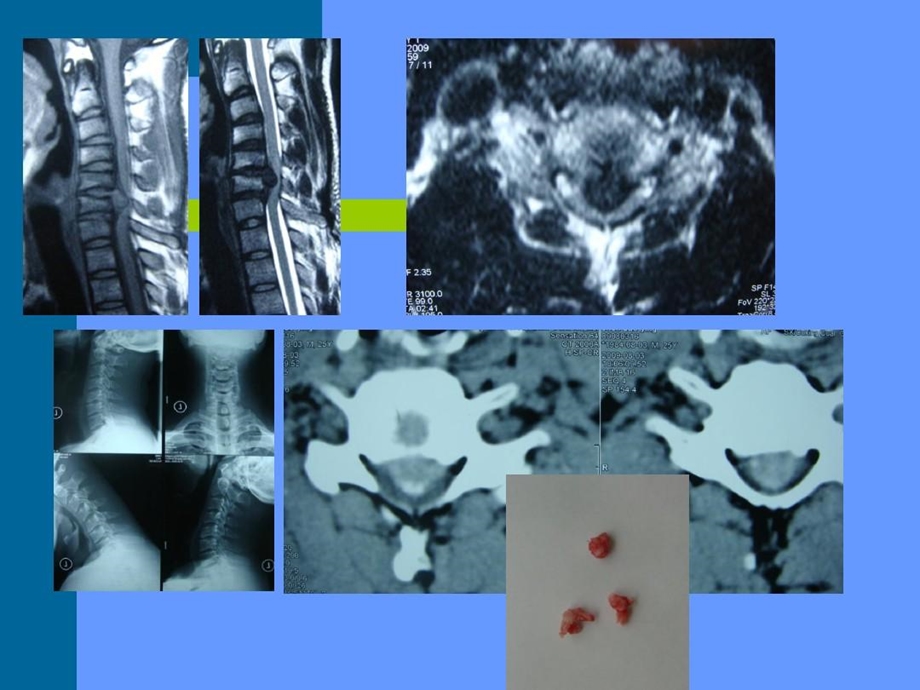 颈椎人工椎间盘置换手术适应证的探讨课件.ppt_第3页