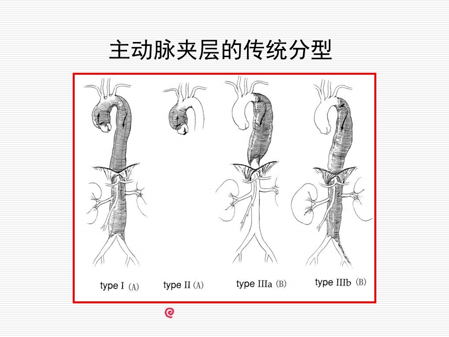 孙氏手术在A型主动脉夹层外科治疗中的应用课件.ppt_第3页