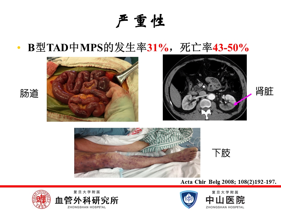 医学交流ppt课件：主动脉夹层低灌注综合征.pptx_第3页