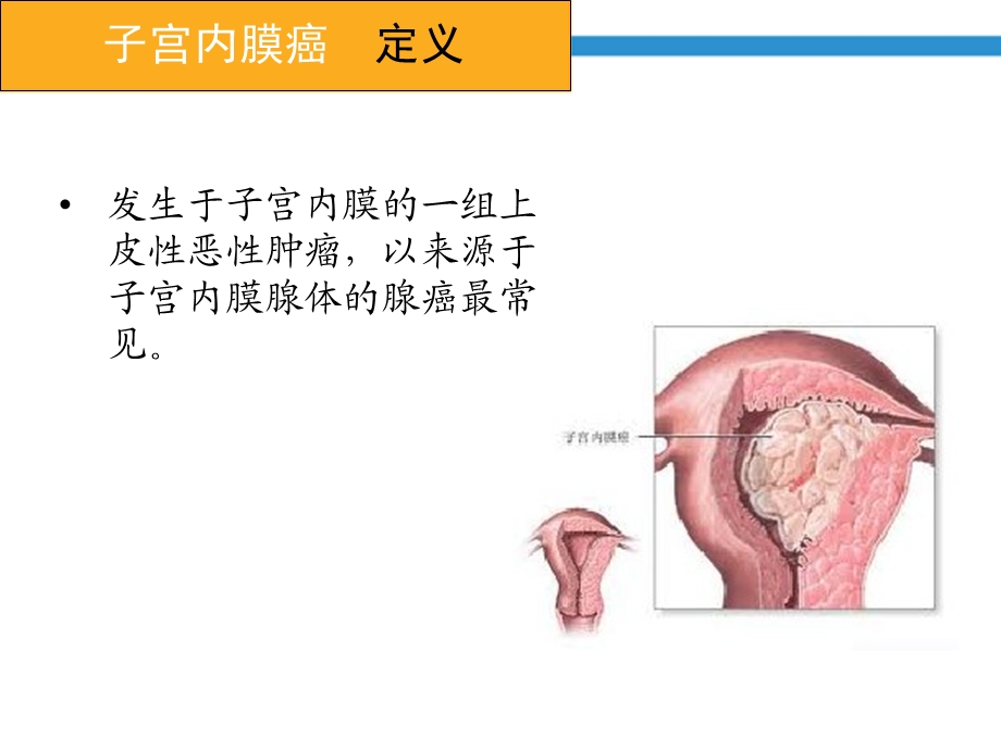 子宫内膜癌病人护理培训ppt课件.ppt_第2页