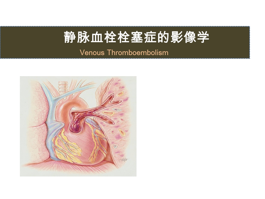 影像巡诊资料：静脉血栓栓塞症的影像学课件.pptx_第1页