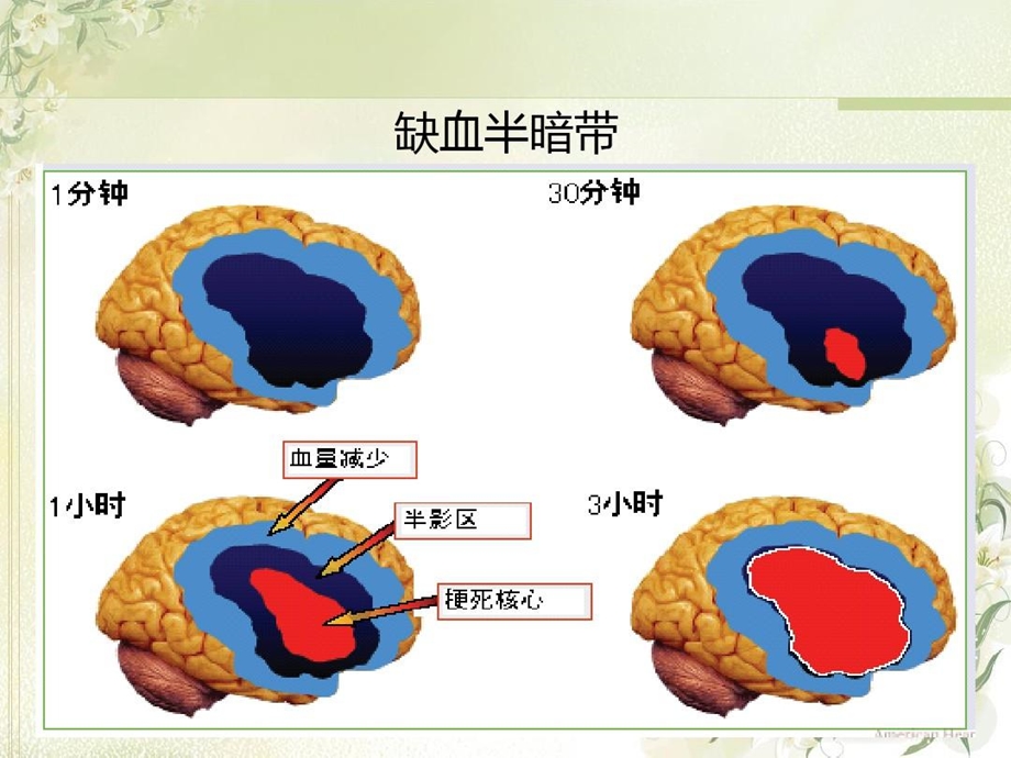 急性脑梗死静脉溶栓完整版本课件.ppt_第2页