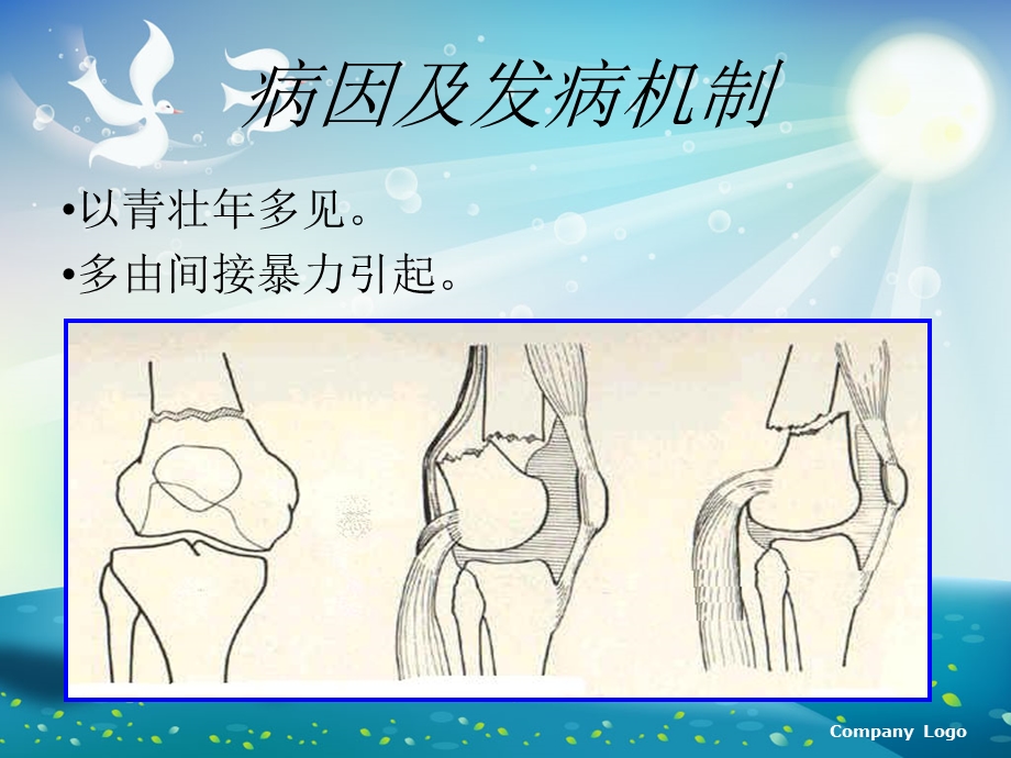 左股骨髁上骨折术后护理终版ppt课件.ppt_第3页