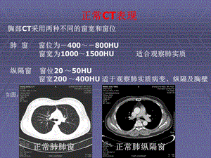 正常胸肺部影像学课件.ppt