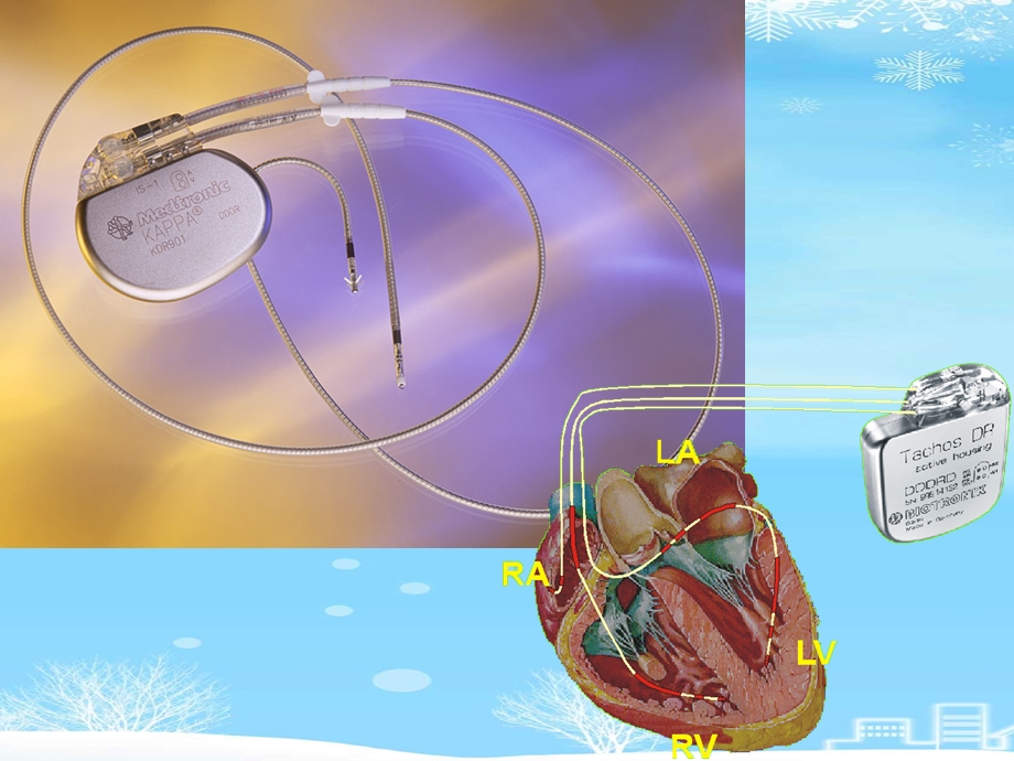 心脏起搏器2021完整版课件.ppt_第2页