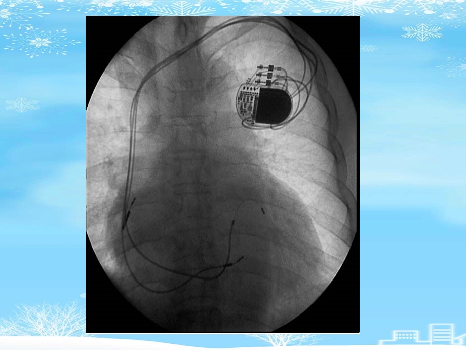心脏起搏器2021完整版课件.ppt_第3页