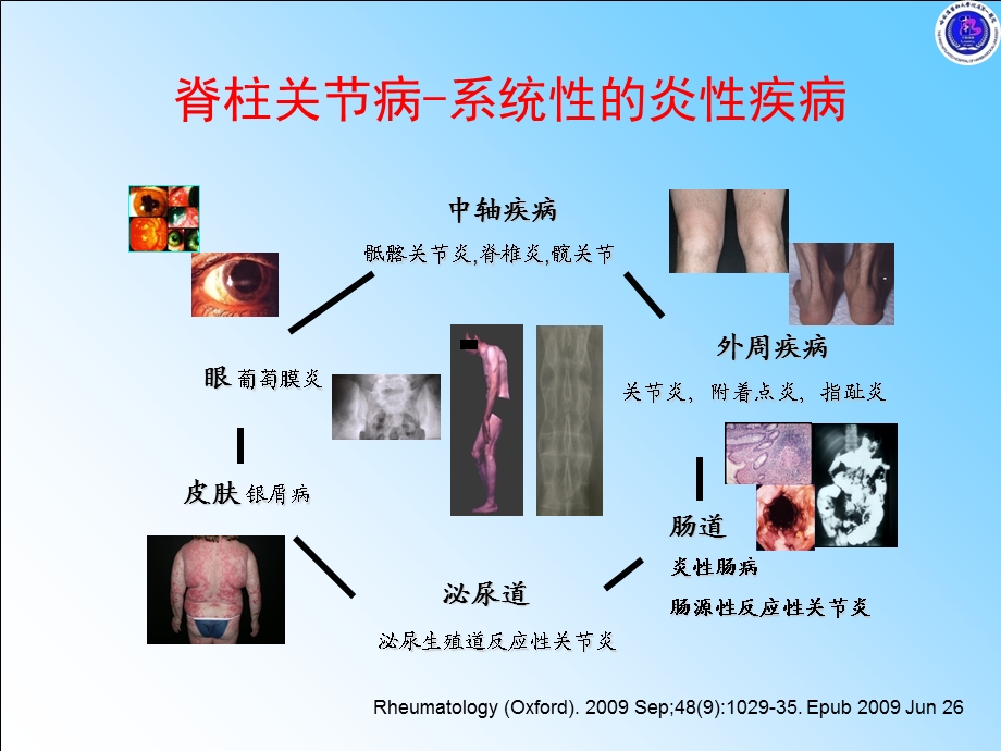 强直性脊柱炎不仅仅在脊柱主题讲座ppt课件.ppt_第2页