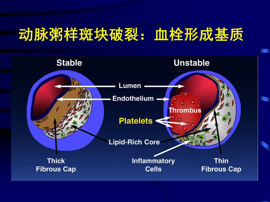 斑块破裂 课件.ppt_第3页