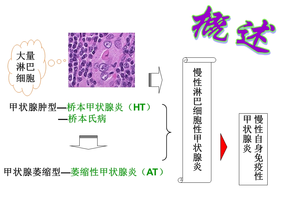 慢性淋巴细胞性甲状腺炎讲稿课件.ppt_第2页